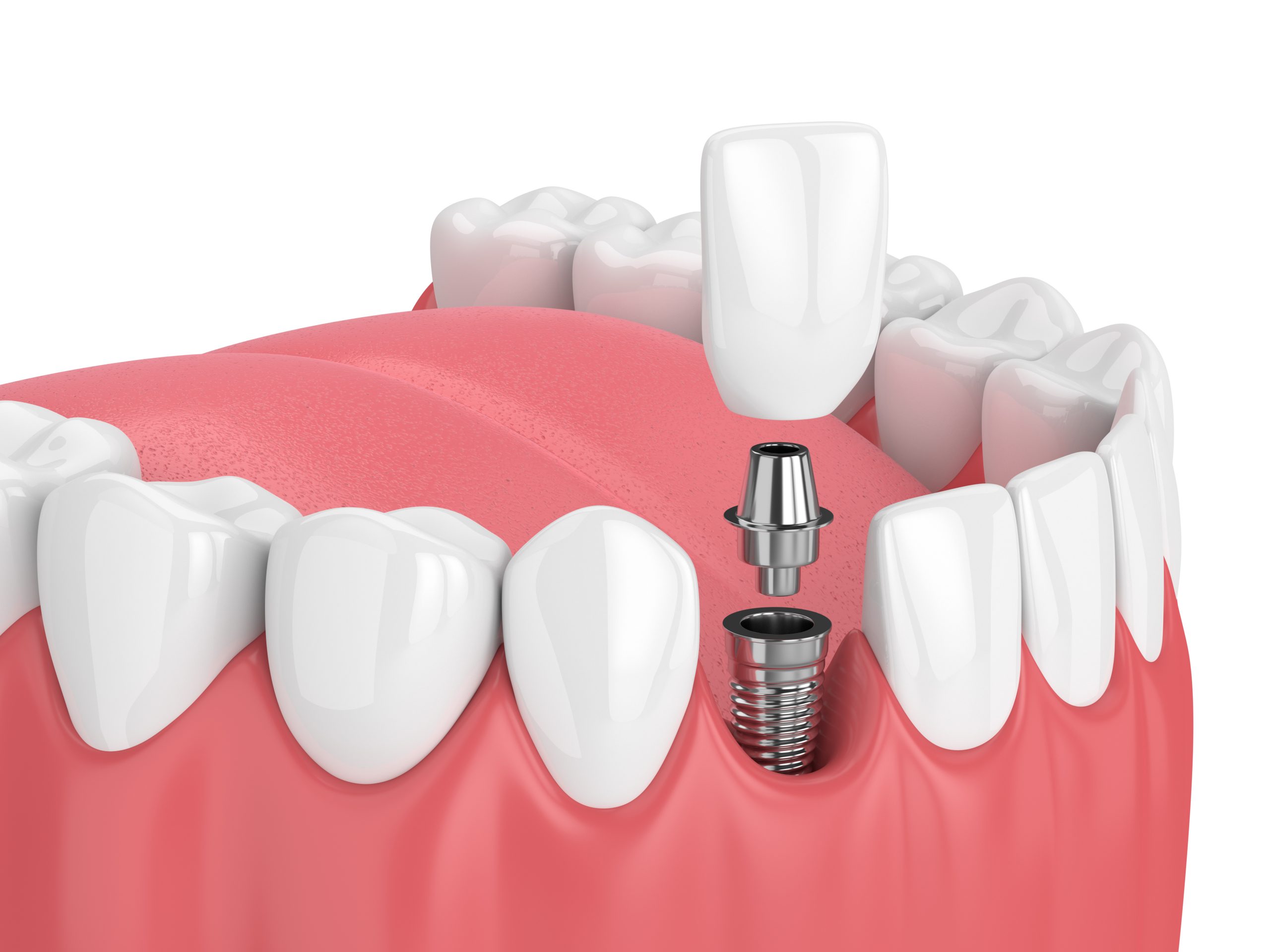 Dental Implants Surrey